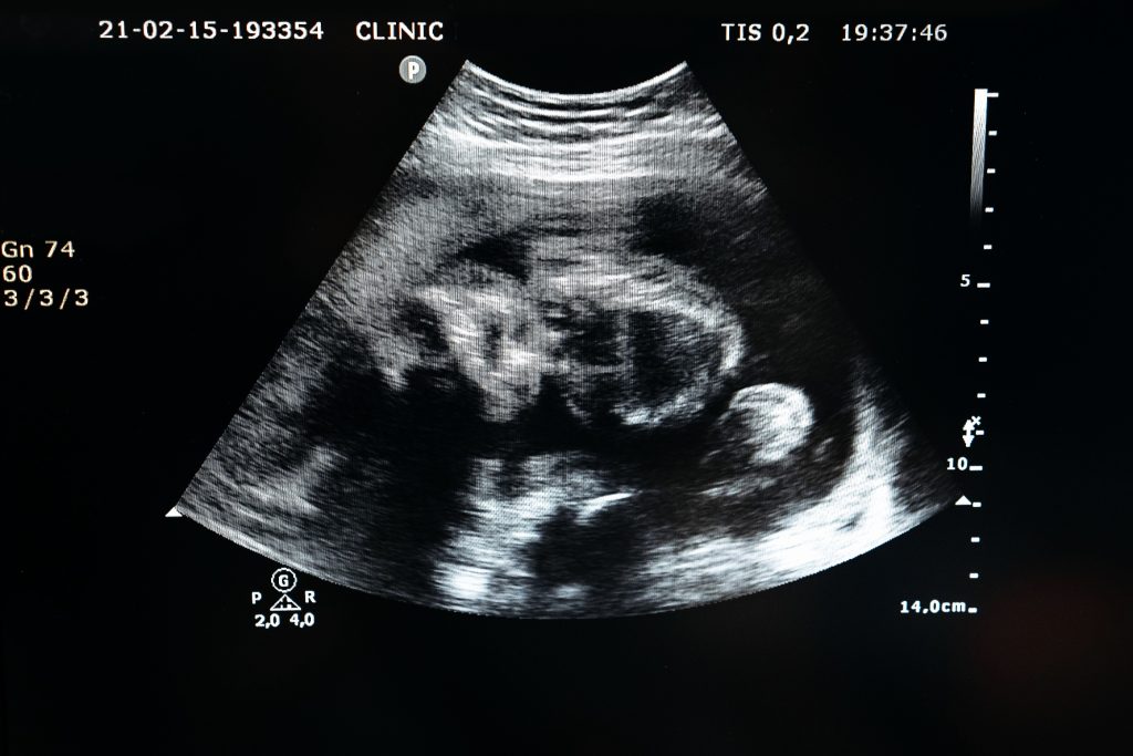 Sulfato de magnesio y preeclampsia: la paradoja de un tratamiento esencial que la ciencia aún descifra