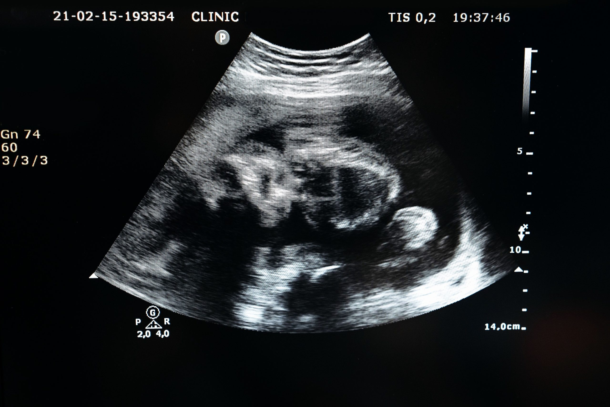 Sulfato de magnesio y preeclampsia: la paradoja de un tratamiento esencial que la ciencia aún descifra