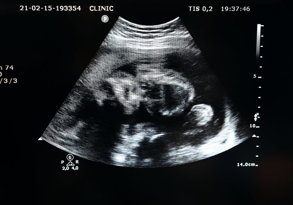 Sulfato de magnesio y preeclampsia: la paradoja de un tratamiento esencial que la ciencia aún descifra